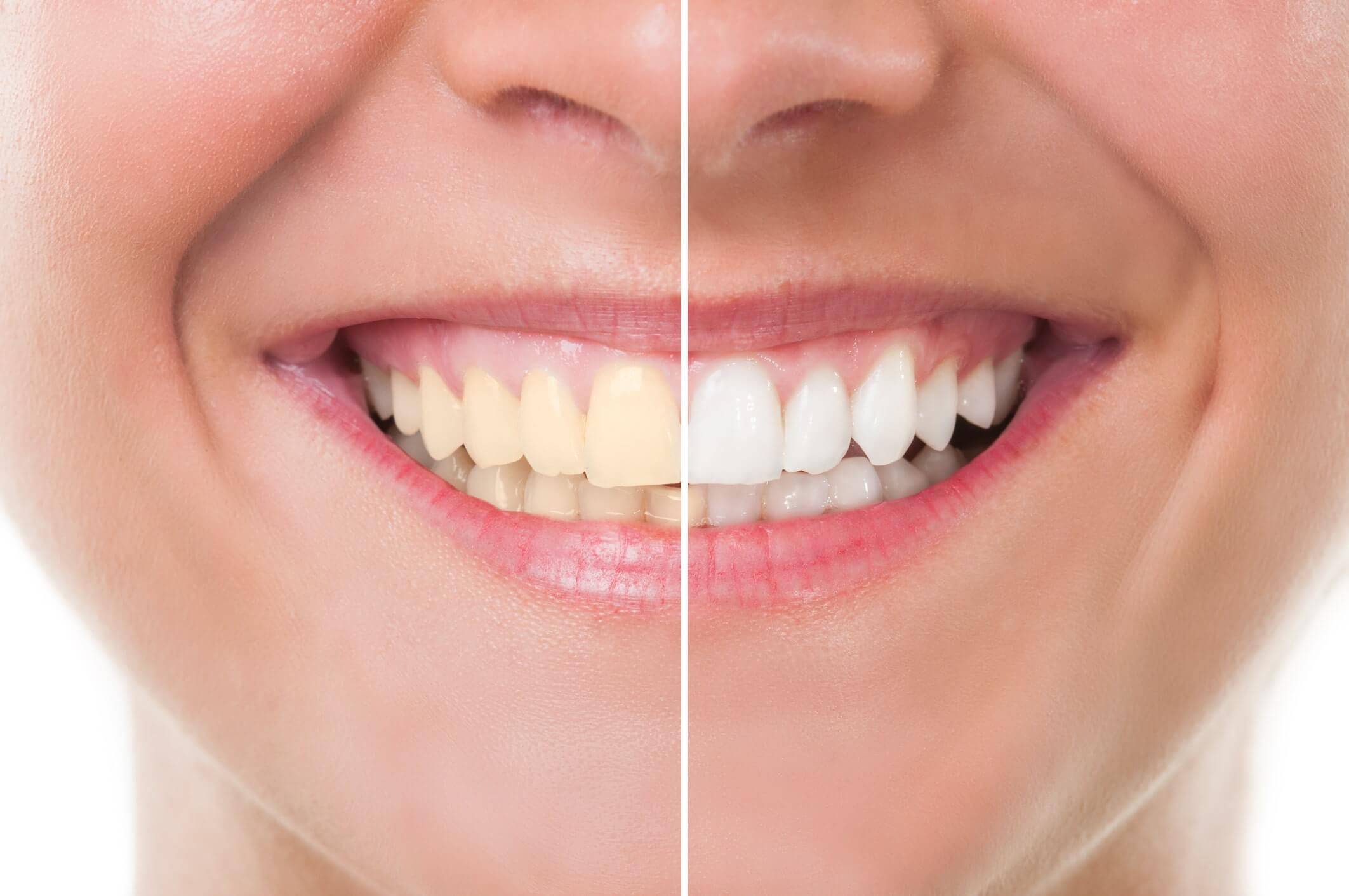 Teeth-Whitening