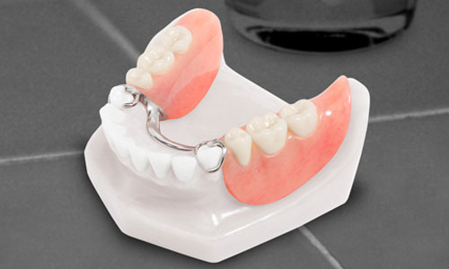 Cast Partial Denture