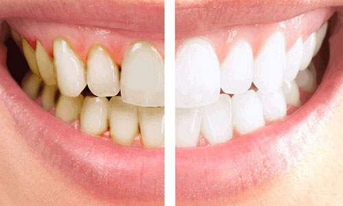 Orthodontic Treatment, Teeth Whitening & Scaling, Cosmetic Dentistry in  Muzaffarnagar