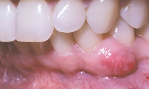 Periapical Cyst