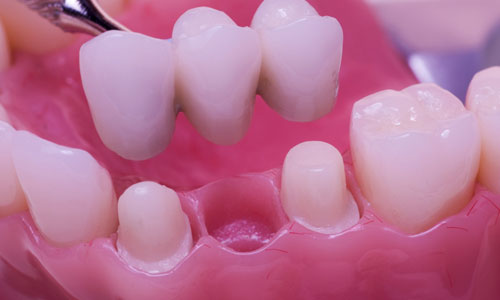 Fixed Denture