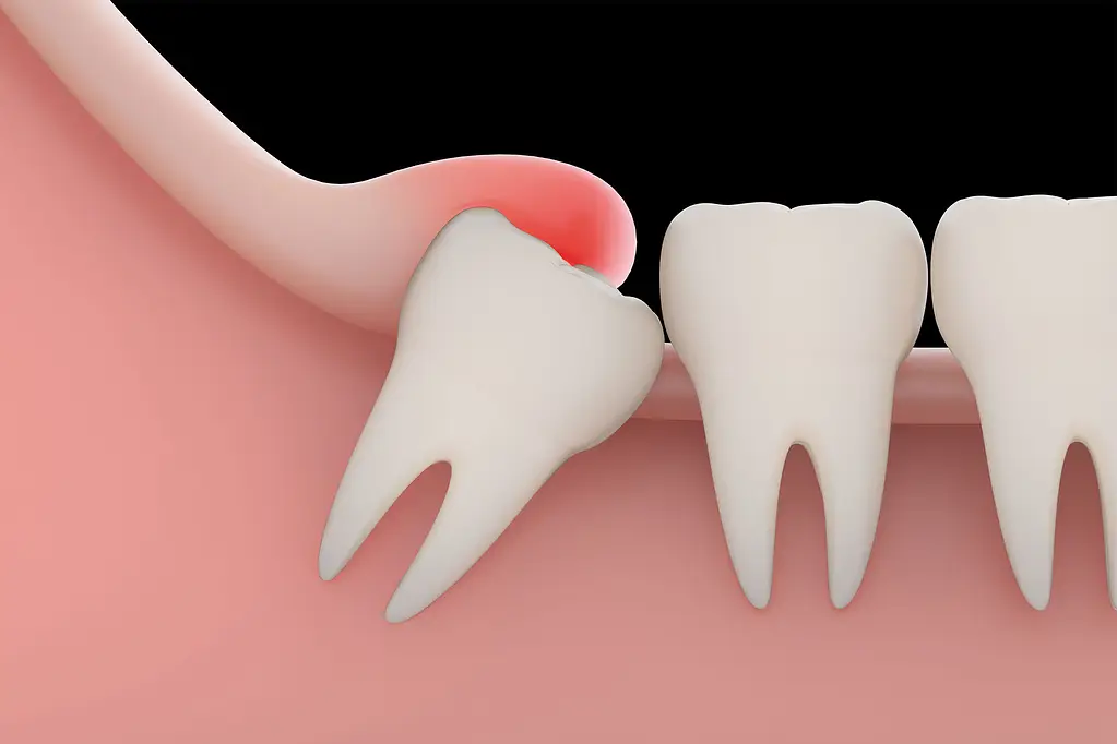 impacted-tooth