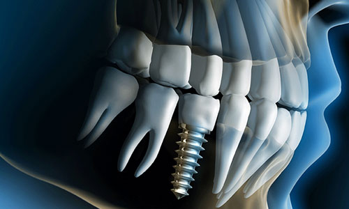 dental implant