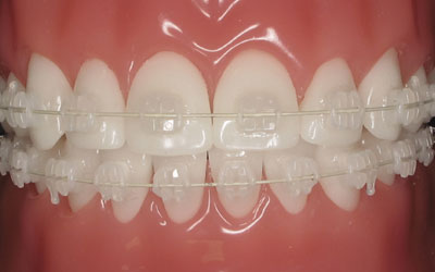 braces-orthodontics