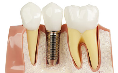 dental-implants