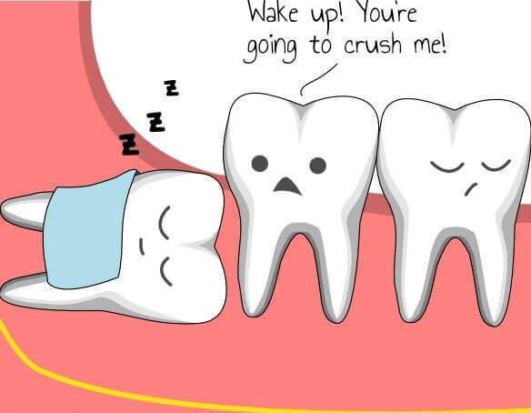 WISDOM TOOTH